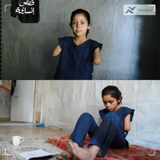 جنایت اسرائیل در غزه؛ دستان دختر فلسطینی قربانی شد