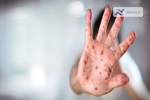 هشدار علیه تبلیغات ضد واکسیناسیون در شبکه‌های اجتماعی