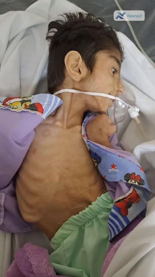 کمک فوری به کودک 8 ساله فلج نیازمند است